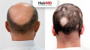 Image result for Alopecia