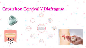 Capuchon Cervical Y Diafragma By Macarena Martinez Vera