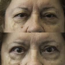 How to flip your eyelids inside out. Floppy Eyelid Syndrome And Sleep Apnea Harris Eyelid Facial Plastic Surgery