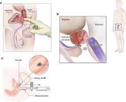 Can be used to discuss and understand. Decision Making In The Treatment Of Prostate Cancer