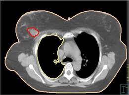 Other terms used are malignant tumours and neoplasms. Breast Cancer A Ct Scan After Breast Conserving Surgery Before Download Scientific Diagram