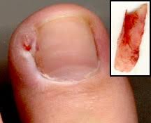 Check spelling or type a new query. Ingrown Nail Wikipedia