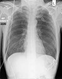 For patients diagnosed with throat cancer, a pet/ct scan may be used to see if cancer has spread to the lymph nodes, to determine the origin of cancer when it is found in the lymph nodes first, or to check the body for the spread of cancer cells. Laryngeal Tumor Squamous Cell Carcinoma Radiology Case Radiopaedia Org