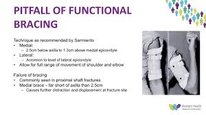 Unisex breathable arm sling elbow humerus brace splint arm injury recovery for correction of arm fracture. Humeral Shaft Fractures Is Sarmiento S Paper Still Relevant By Dr Dharsh Musiienko Youtube