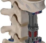 Vertebral Body Replacement Devices | Musculoskeletal Key