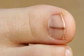 Patients should also protect their hands with gloves while working in the yard or using cleaning products. Nail Melanoma South East Skin Clinic