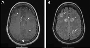 Image result for Brain Lesion