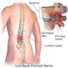 Typically, this is where people tend to place too much pressure, such as: Lower Back Pain Causes Herniated Disc Bulging Disc