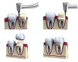 Wann ist eine krone für einen zahn notwendig? Kronen Und Teilkronen Zahnarzt Koln Maarweg