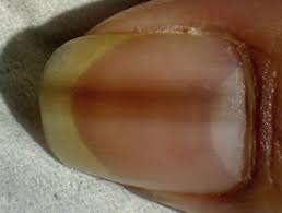 A woman has shared a warning in which she claims that finding a black line down your nail could be a sign of cancer. Melanonychia Dermnet Nz