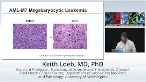 Erythroid and Megakaryoblastic Leukemia; from Models to Targeted Therapy