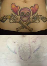 Puente's office and are spaced four to eight weeks apart. Tattoo Removal Cpmedspa Laser Skin