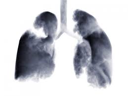 Her brain mri and bone scan came back clear however, the ct scan of her lower abdomen came back with a mass on her right ovary (same side as the 8cm tumor lower lung) that is 4cm. Small Cell Lung Cancer Chest Radiotherapy Prolongs Survival Reduces Recurrence