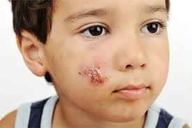 Image result for yellow scabs on the face in children