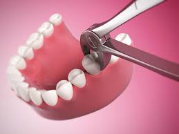 Image result for Tooth Extraction