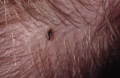 Image result for What Are Good Treatments for Head Lice"