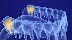 We did not find results for: Wisdom Tooth Extraction Cost In Los Angeles With Insurance