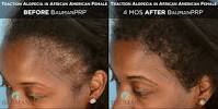 Braid Hairstyles For Receding Hairline African Female
