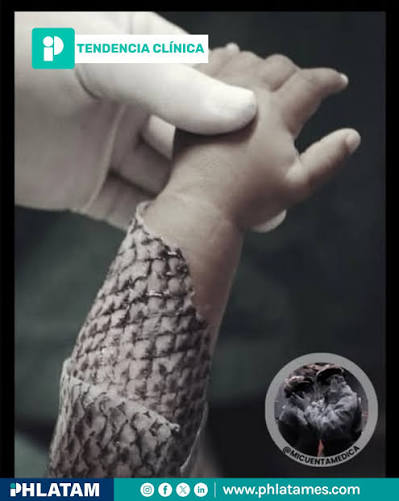 TendenciaClínica | La piel de tilapia está cambiando la vida de miles de  personas que han sufrido quemaduras en todo el mundo. ¿Cómo funciona? Es  rica en colágeno tipo I, la proteína