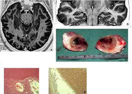 Developmental tumors and adjacent cortical dysplasia: Single or dual  pathology?