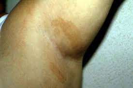 Image result for Intertrigo under breasts