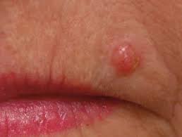 Although the percentage of cases in men is much lower than in women, male breast cancer accounts for a por. Keratinocyte Cancer Dermnet Nz