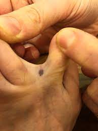 This form of skin cancer is considered less serious than others but should be removed. Only Just Noticed This Between My Toes First Time I Ve Seen This In My Life And I M 35 Any Ideas Skincancer