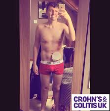 Student Luke Bennett Posts Colostomy Bag Selfie That Goes Viral As Thousands Back Brave Crohn S Sufferer Mirror Online