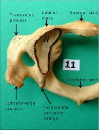 It is named for atlas of greek mythology because, just as atlas supported the globe, it supports the entire head. Epitransverse Process A Rare Outgrowth From Atlas Vertebra Semantic Scholar