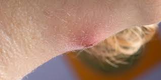 So erkennst du ihn und so behandelst du ihn Eiterpickel Am Bauch