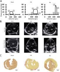 Gebauer's pain ease approximate cost comparison. Asymmetric Regional Work Contributes To Right Ventricular Fibrosis Inefficiency And Dysfunction In Pulmonary Hypertension Versus Regurgitation Journal Of The American Society Of Echocardiography