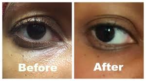 How I Corrected My Saggy Hooded Eyelid Without Surgery Eye Exercises Saggy Eyelids Hooded Eyelids