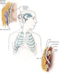 Treatment And Outcomes Section 4 Adult Hydrocephalus