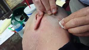 Shaving can cause ingrown hairs. Ingrown Hair On Head Galhairs