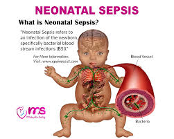 Image result for Neonatal Sepsis