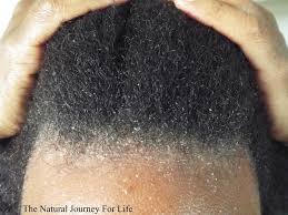 Below, some tips and tricks for how to address your head. Is That Dandruff Or Something More Serious Natural Hair Scalp Dry Scalp Treatment Hair Problems Dandruff