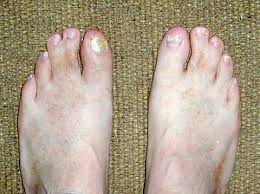 There are 5 webbed toes for sale on etsy, and they cost $16.57 on average. World Wide Webbed Toes