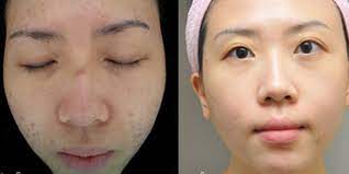 Laser Pore Treatment Enlarged Pores Treatment Q A Tips Nexus Clinic