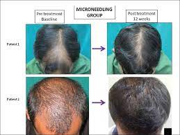 Learn how it's done, health risks, safety tips, and how to take care of your skin afterward. Microneedling For Hair Loss What S The Best Needle Length It Depends
