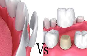تاج دندان پزشکی چیست ؟ 
