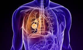 Types Of Lung Cancer: Common, Rare, Aggressive & More | Ctca