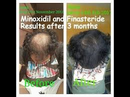 Happy head topical finasteride is a hair regrowth product created by dr. Pin On Cura Capelli