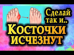 как лечить косточку на ноге в домашних условиях отзывы Kak Ostanovit Rost Kostochki Na Bolshom Palce Stopy Youtube