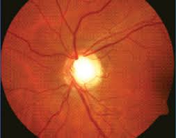 Glaucoma is actually a group of diseases, but the common feature among all types of glaucoma is optic nerve degeneration. How To Evaluate The Suspicious Optic Disc