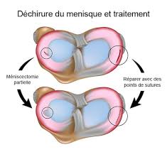 >>> un espoir pour les fissures du menisque bonjour ! Menisque Et Genou Quand Operer Dr Jacquel