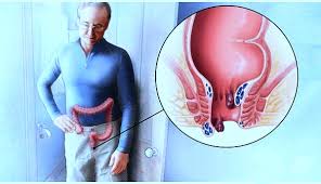 اسباب تورم فتحة الشرج وعلاجه صحتنا