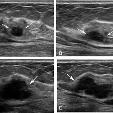 On the flip side, there are benign (not cancerous) breast changes which can mimic breast cancer as well. Breast Ultrasound Images For A 46 Year Old Woman With An Invasive Download Scientific Diagram