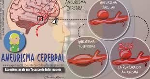 Un aneurisma cerebral es una condición potencialmente mortal que puede afectar a una persona a cualquier edad. El Aneurisma Cerebral Enfermagem Ilustrada
