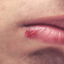 It also varies depending on the. Herpes Simplex Virus Oral And Genital Herpes Poz