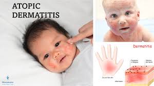 Image result for Atopic eczema atopic dermatitis